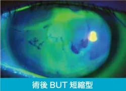 ドライアイの診断 術後BUT短縮型