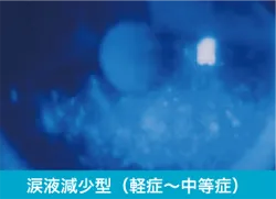 ドライアイの診断 涙液減少型（軽症〜中等度）