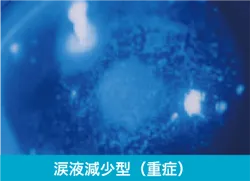 ドライアイの診断  涙液減少型（重症）