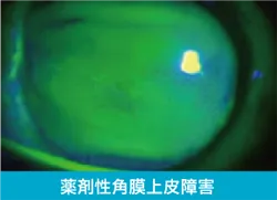 ドライアイの診断  薬剤性角膜上皮障害