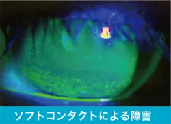 ドライアイの診断 ソフトコンタクトレンズによる障害