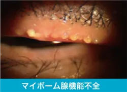 ドライアイの診断 マイポーム腺機能不全