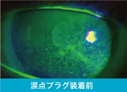 涙点フラグ装着前