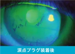 涙点フラグ装着後