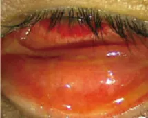 ウイルス性結膜炎の症状