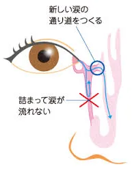 涙嚢鼻腔吻合術