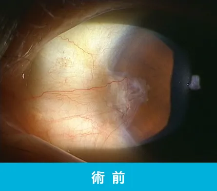 翼状片の手術前の目の状態