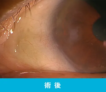翼状片の手術後の目の状態