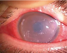 アカントアメーバ角膜炎の眼の状態