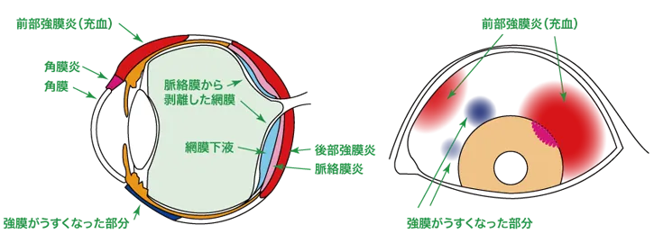 強膜炎・上強膜炎の状態を説明する画像