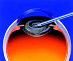 水晶の中身を吸い出すイメージ画像
