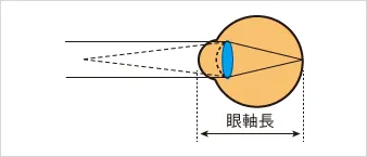 正常な屈折のイメージ