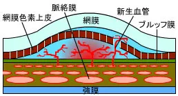 加齢黄斑変性の滲出型を表すイラスト