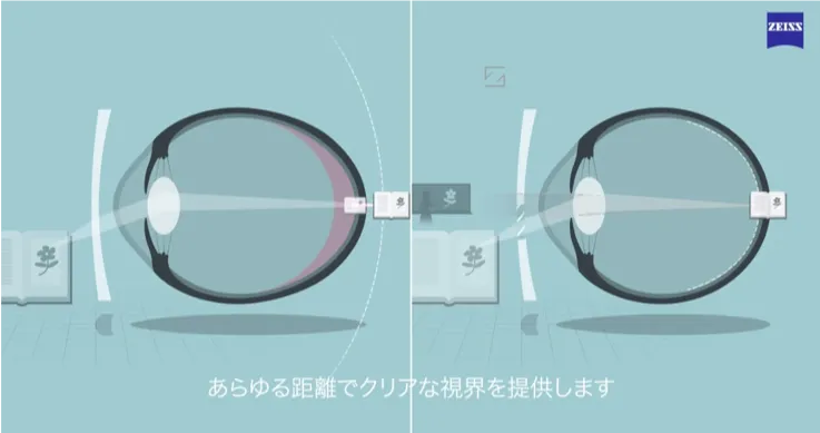 マイオキッズレンズをかけた時の見え方のイメージ