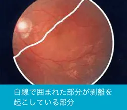 網膜剥離 - 目の病気 - スカイビル眼科