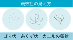 飛蚊症の見え方