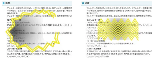 ギザギザした稲妻のような光、視界の一部が見えにくくなる現象