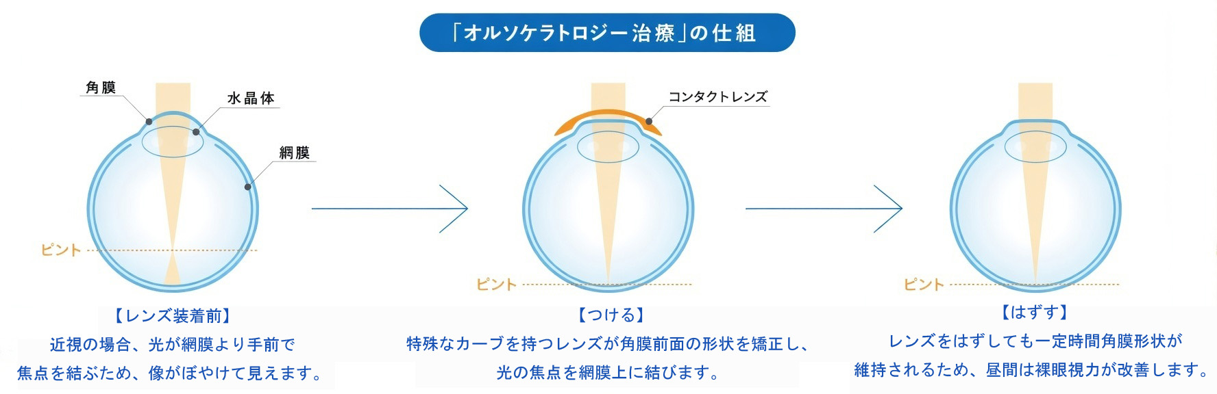 オルソケラトロジー治療の仕組み