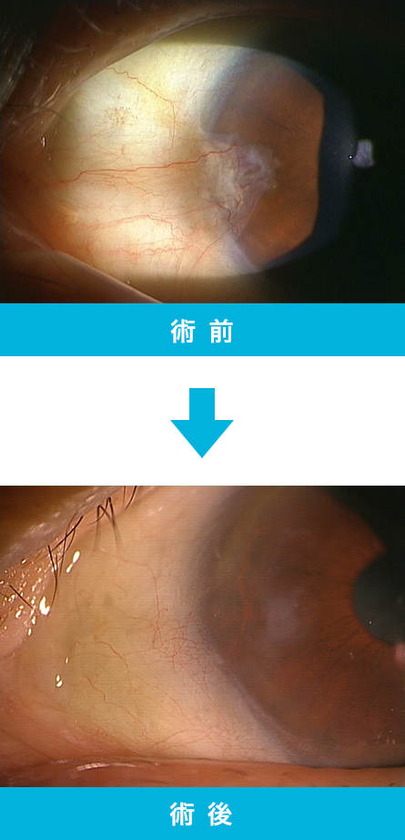 翼状片 治療