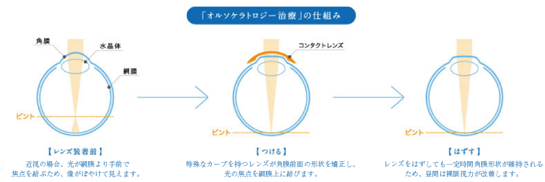 オルソケラトロジー