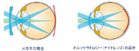 オルソケラトロジーコンタクトレンズの近視抑制効果