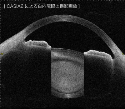 CASIA2による白内障眼の撮影画像