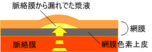 中心性漿液性網脈絡膜症原因 脈絡膜から漏れでた漿液