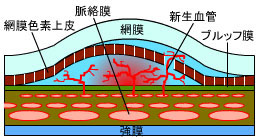 加齢黄斑変性